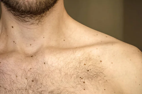 The clavicle of a young man. Moles — Stock Photo, Image