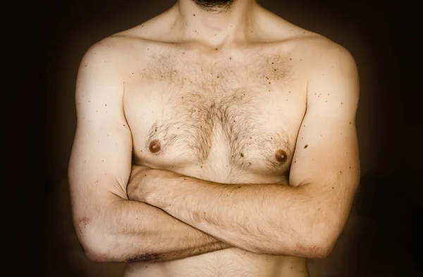 Moles no peito de um homem . — Fotografia de Stock