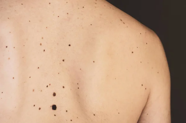 Moles on the back of a man. — Stock Photo, Image