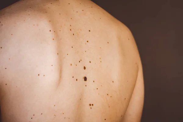 Moles on the back of a man. — Stock Photo, Image