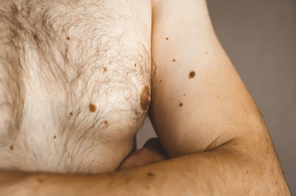 Moles no peito de um homem . — Fotografia de Stock