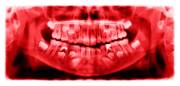 Panoramic Radiograph Scanning Dental Ray Upper Jaw Maxilla Lower Jawbone — Stock Photo, Image