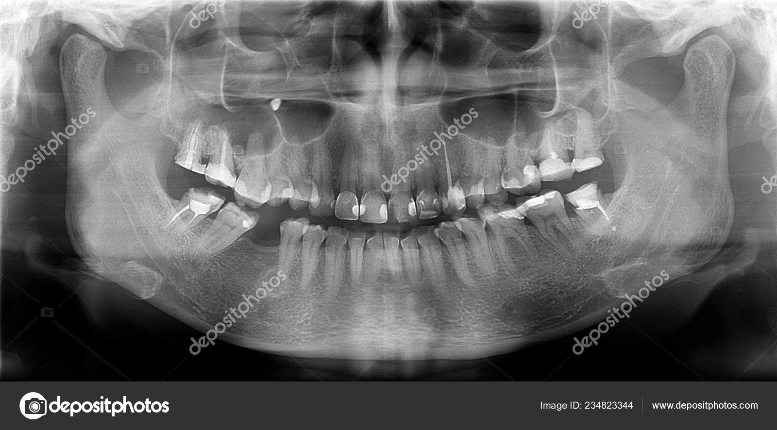 Panoramic Radiograph Panoramic Scanning Dental Ray Upper Lower Jaw