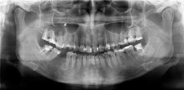 Panoramic radiograph is a panoramic scanning dental X-ray of the upper and lower jaw. This is a focal plane tomography depicting the maxilla and mandible of a thirty-year-old woman. clipart
