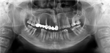 A panoramic radiograph is a panoramic scanning dental X-ray of the upper and lower jaw. This is a focal plane tomography shows the maxilla and mandible of a forty year old man. clipart