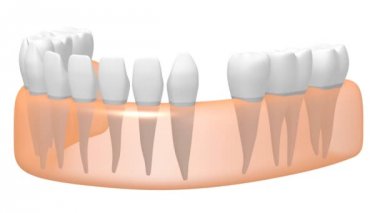 3D diş implant / diş protezi animasyon - beyaz arka plan üzerinde.