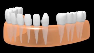 3D diş implant / diş protezi animasyon - siyah arka plan üzerine.