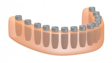 3D diş implantları / Diş implantları animasyon - beyaz arka plan üzerinde.