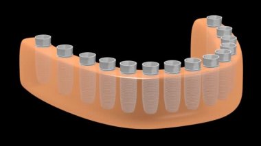 3D diş implantları / Diş implantları animasyon - siyah arka plan üzerine.