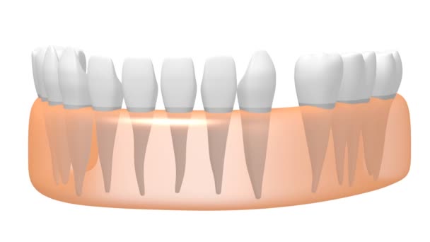 Fogászati Implantátum Fog Implantátum Animáció Fehér Háttér — Stock videók