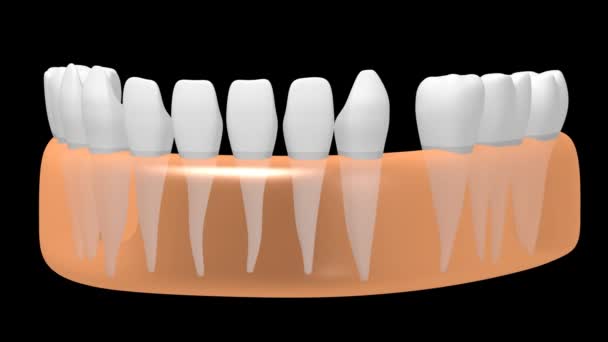 Dental Implant Tand Implantaat Animatie Zwarte Achtergrond — Stockvideo