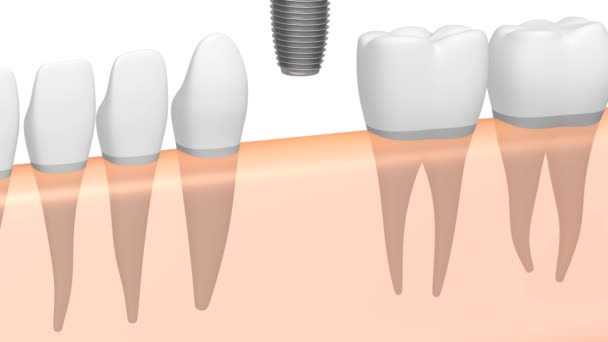 Dental Implant Tooth Implant Animation White Background — Stock Video ©  3d_generator #238563362