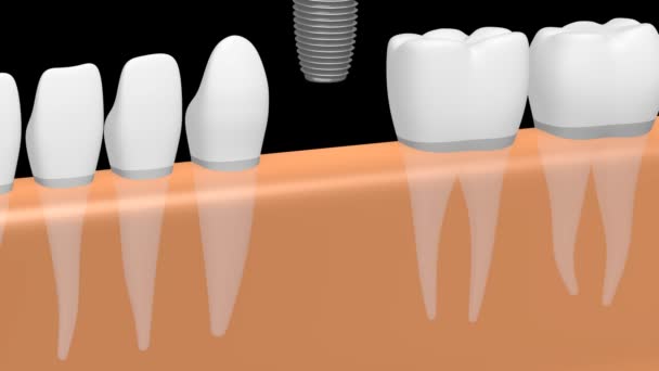 Fogászati Implantátum Fog Implantátum Animáció Fekete Háttér — Stock videók