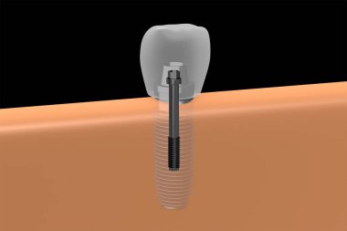 Diş implantı / implant diş