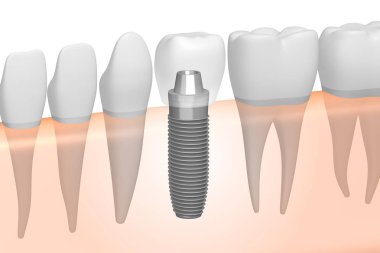 Diş implantı / implant diş