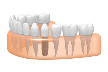 Diş implantı / implant diş