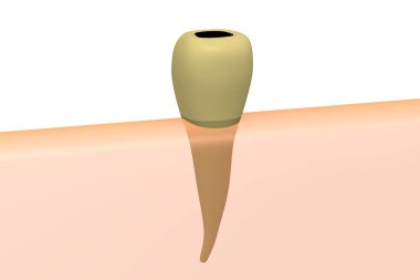 3D çürük diş - illüstrasyon