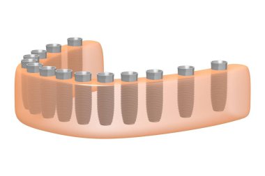 Diş implantları / Diş implantları
