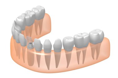 Diş implantı / implant diş