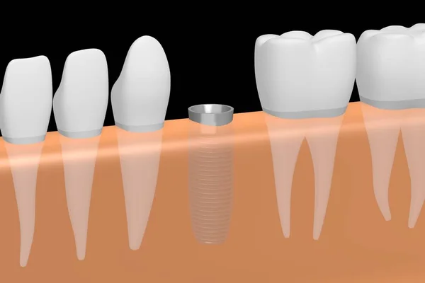 Zubní Implantát Zubní Implantát — Stock fotografie
