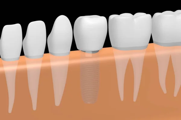 Dental Implant Ząb Implantu — Zdjęcie stockowe