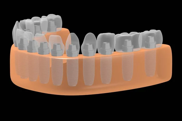 Implantes Dentários Implantes Dentários — Fotografia de Stock