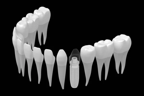 Dental Implant Ząb Implantu — Zdjęcie stockowe