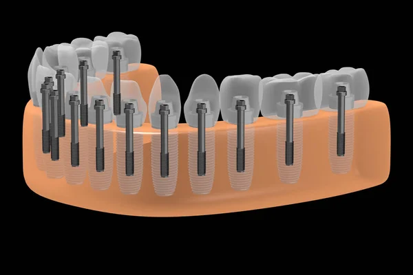 Implantes Dentales Implantes Dentales — Foto de Stock