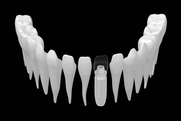 Implante Dental Implante Dental — Foto de Stock