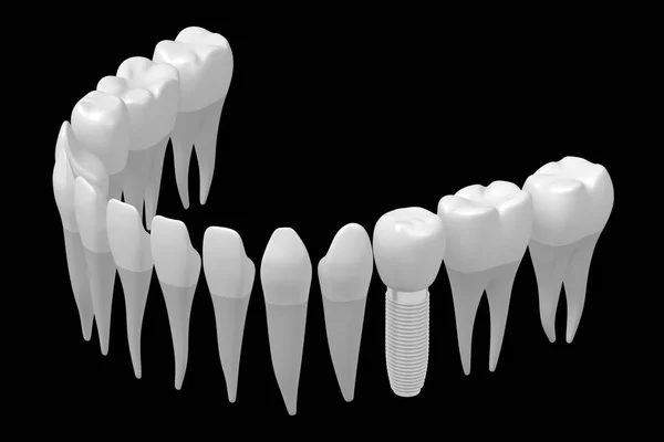 Dental Implant Implantaat Tands — Stockfoto