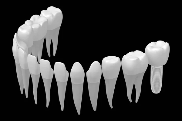 歯科インプラント 歯のインプラント — ストック写真