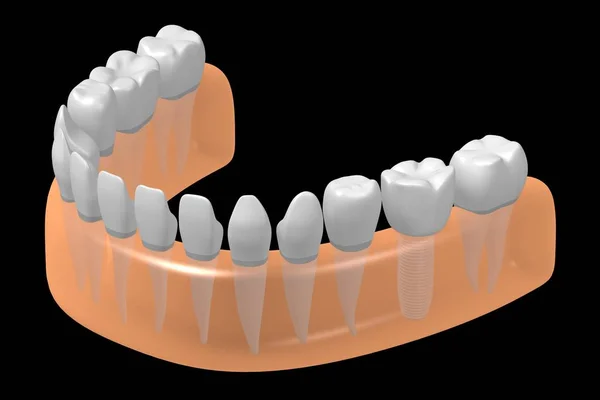 Implante Dental Implante Dental — Foto de Stock