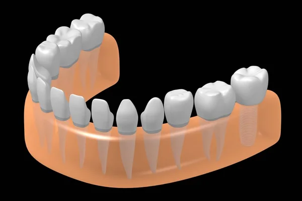 Implante Dental Ilustración — Foto de Stock