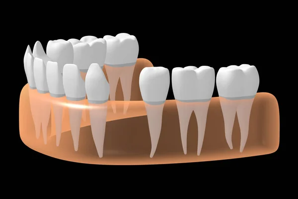 Fehlender Zahn Illustration — Stockfoto