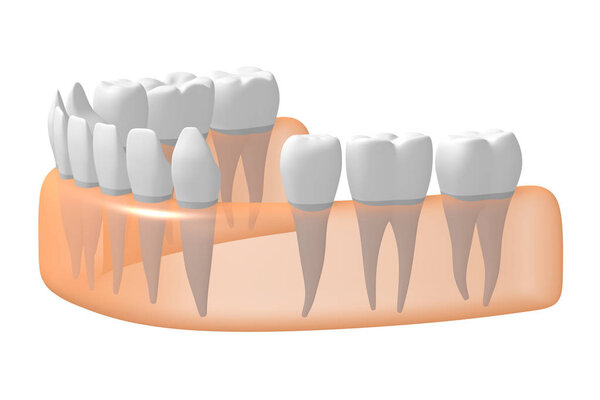 3D missing tooth - illustration