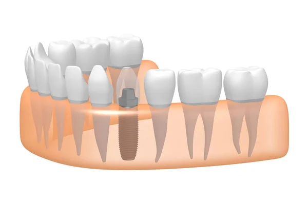 Dental Implant Implantaat Tands — Stockfoto