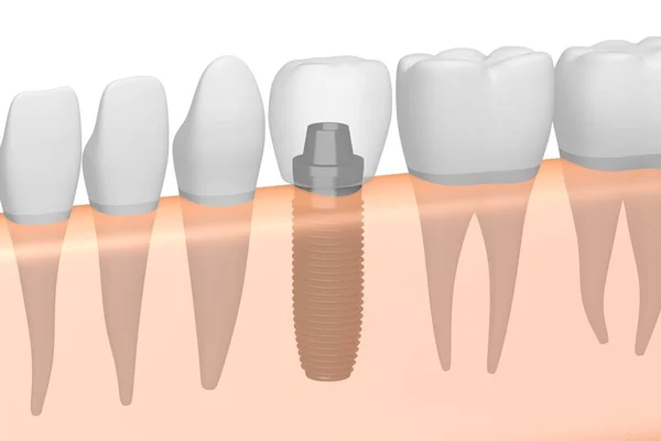 Diş Implantı Implant Diş — Stok fotoğraf