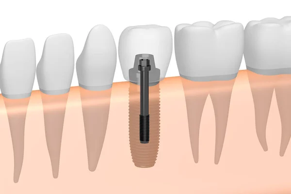 Diş Implantı Implant Diş — Stok fotoğraf