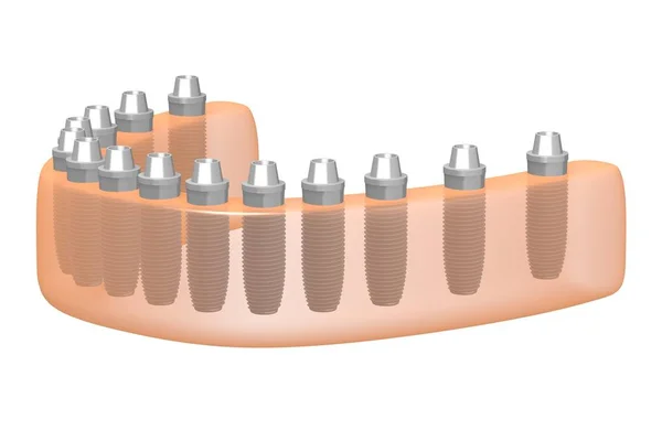 Implanty Zębów Implanty Zębowe — Zdjęcie stockowe