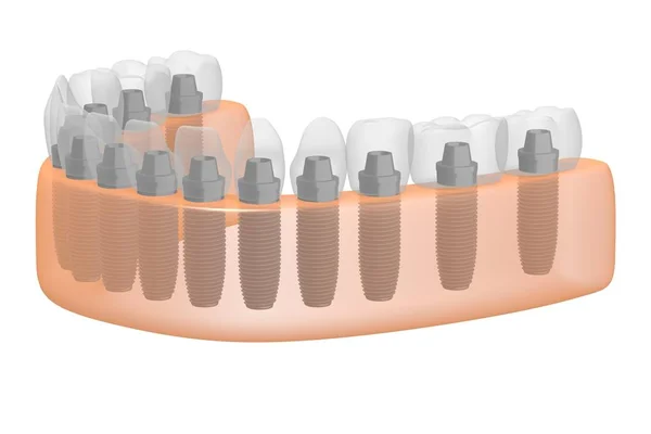 Implantes Dentales Implantes Dentales — Foto de Stock