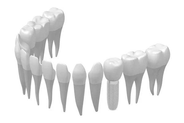 Dental Implant Tooth Implant — Stock Photo, Image