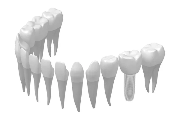 Dental Implant Ząb Implantu — Zdjęcie stockowe