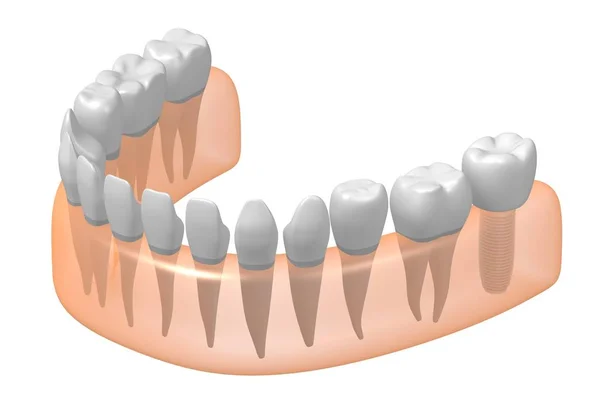 Implante Dentário Implante Dentário — Fotografia de Stock