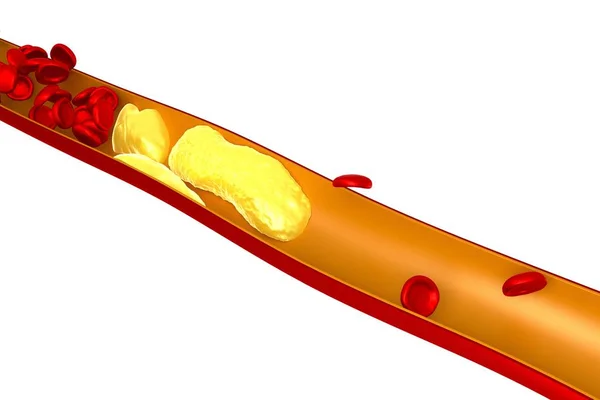 3D холестерин, тромб, красные кровяные тельца — стоковое фото