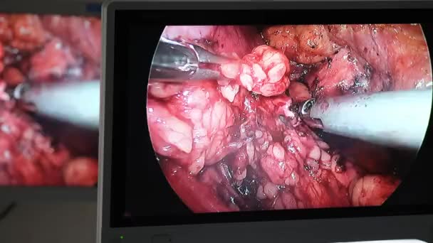 医師は 脂肪の男の腹腔で手術を行うために内視鏡やビデオカメラを使用しています 医療における新技術 モニター上の腹腔鏡手術 — ストック動画