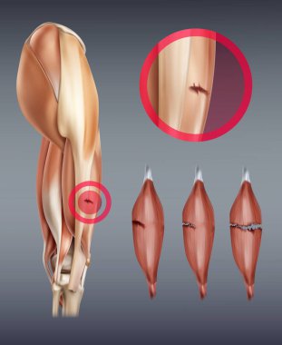 Vektör çizim farklı aşamalarında üzerinde arka izole yırtığı ile bacak kas yaralanması