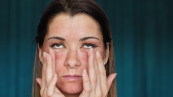 La chica con hematomas en la cara. Láser fraccional. Consecuencias del procedimiento de cosmetología. La mujer siente su cara hinchada . — Vídeos de Stock