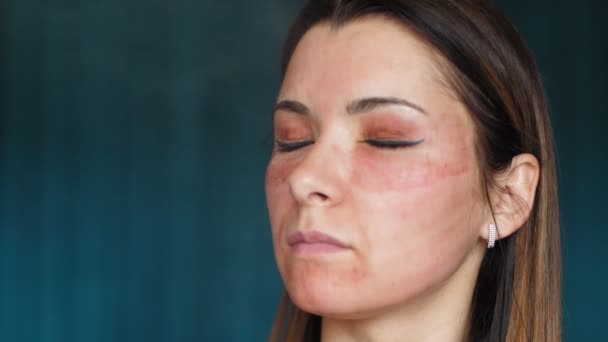 La chica con hematomas en la cara. Láser fraccional. Consecuencias del procedimiento de cosmetología. Mujer hidratante medicamento cicatrizante facial. Rocía. Movimiento lento — Vídeos de Stock