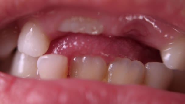 Dětské zuby makro střílet. Bezzubý úsměv. Viklavý zub. Vyřezávám kořenový zub. Jazyk v díře mezi zuby. — Stock video