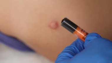 Doktorlar tıbbi eldiven veriyorlar ve ellerinde bir şırıngayı yakın plan çekiyorlar. Yaraların iyileşmesi için yapılan prosedür..